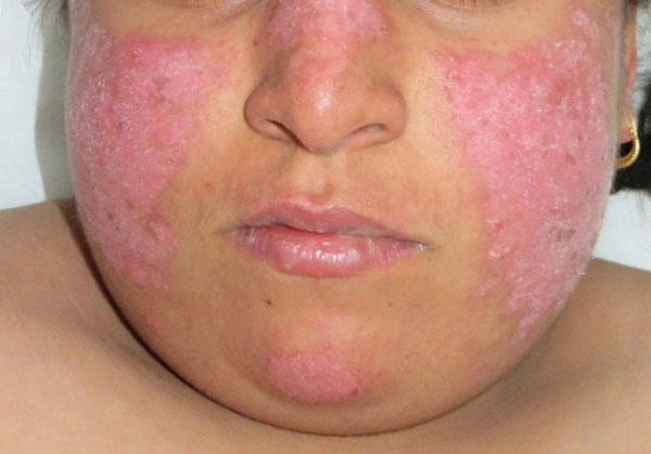 Mảng đỏ nổi trên bề mặt da là triệu chứng bệnh lupus ban đỏ dạng đĩa